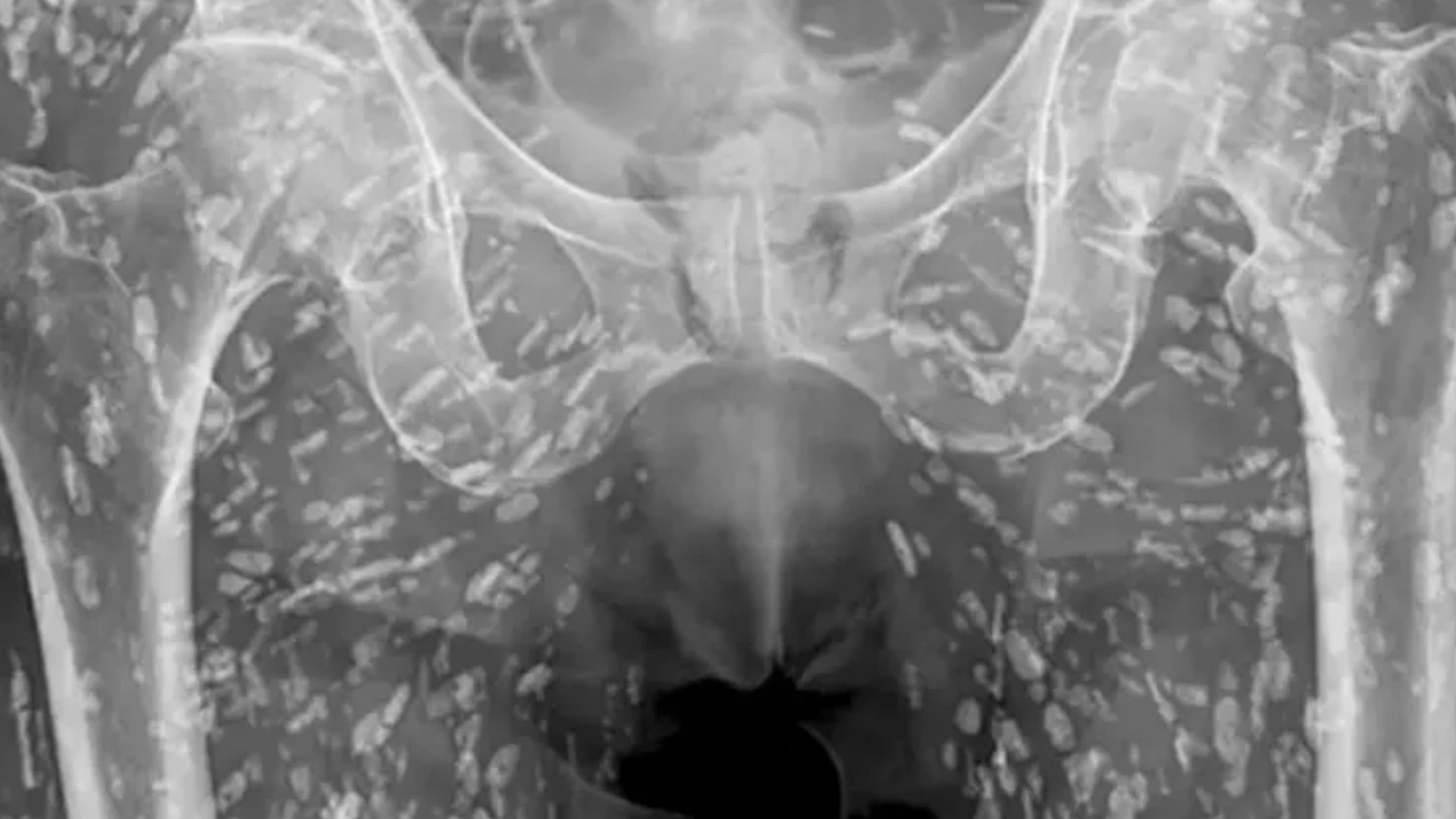 Mand lavede stor fejl i køkkenet: Lægerne fik et chok, da de så hans ‘vilde’ røntgenbillede