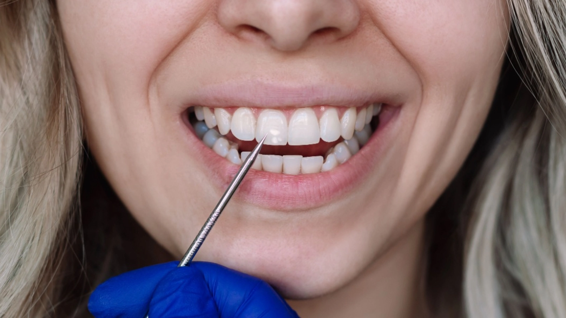 Tandlæge advarer mod ‘sunde’ fødevarer, der kan forårsage huller i tænderne