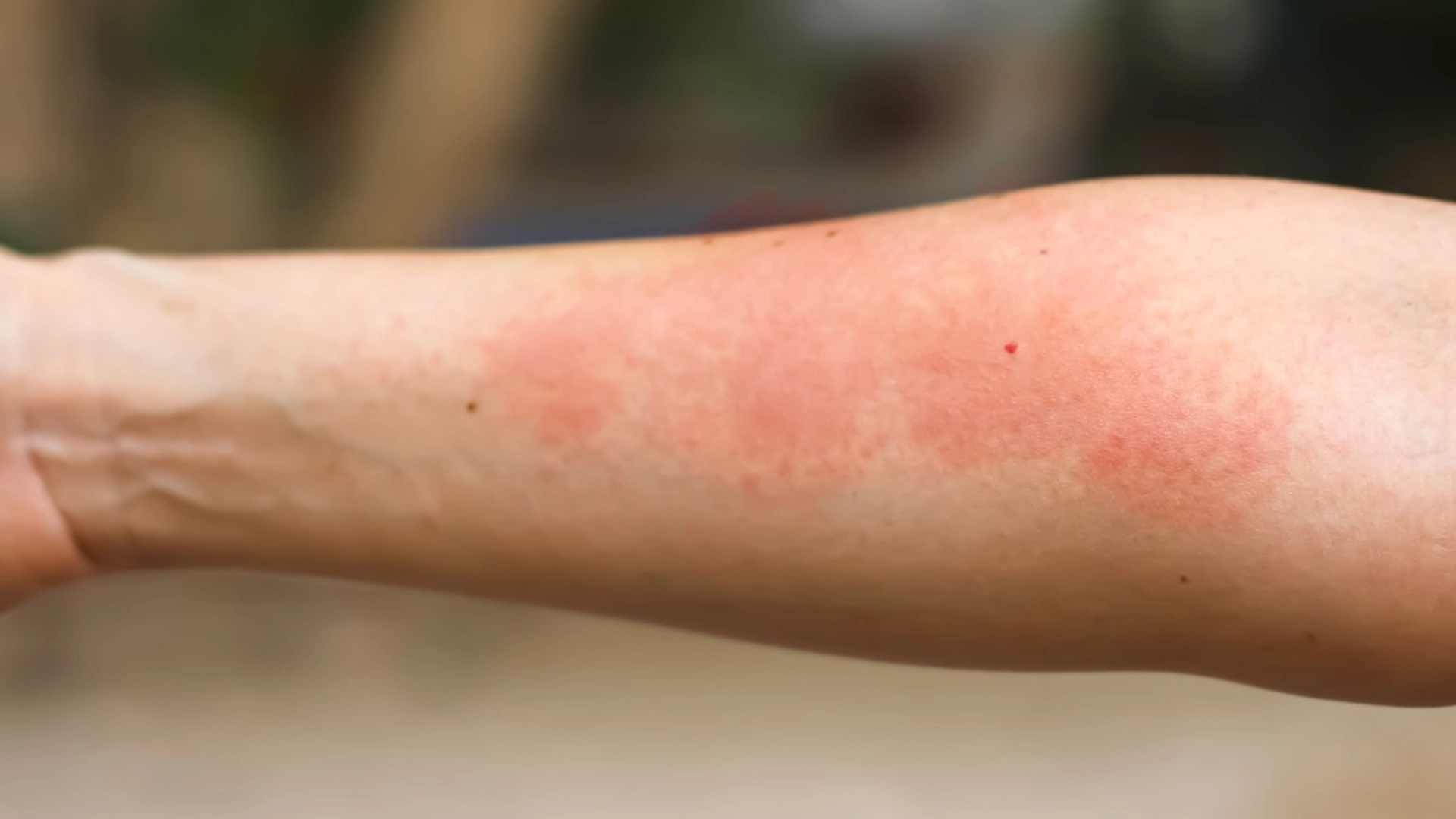 Ekspert med advarsel: Pluk ikke denne almindelige blomst – kan give smertefulde udslæt