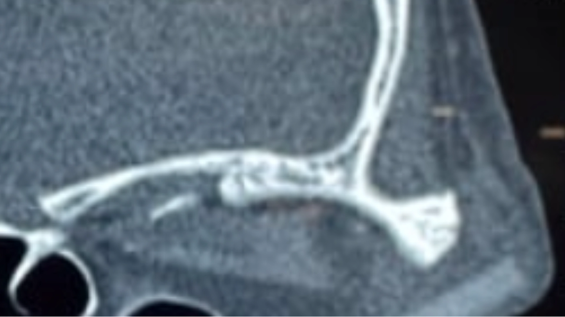 Mand gik til lægen med hævet øje: Hvad der har siddet fast i 3 uger, får folk til at tabe kæben