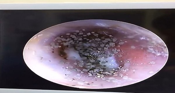 Læger fandt skimmelsvamp i 10-årig drengs øre: Nu advarer de om dårlig vane blandt børn