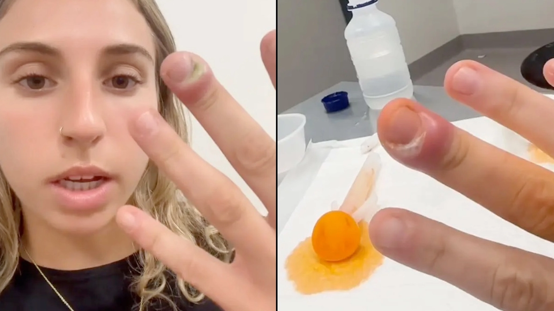 23-årig kvinde med vild afsløring: Sådan gjorde en almindelig vane, at jeg endte på skadestuen