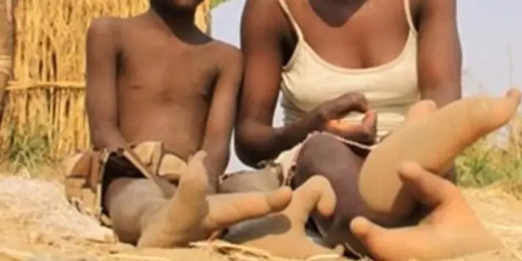 En afrikansk stamme tiltrækker opmærksomhed på grund af en genetisk mutation, der deformerer deres fødder
