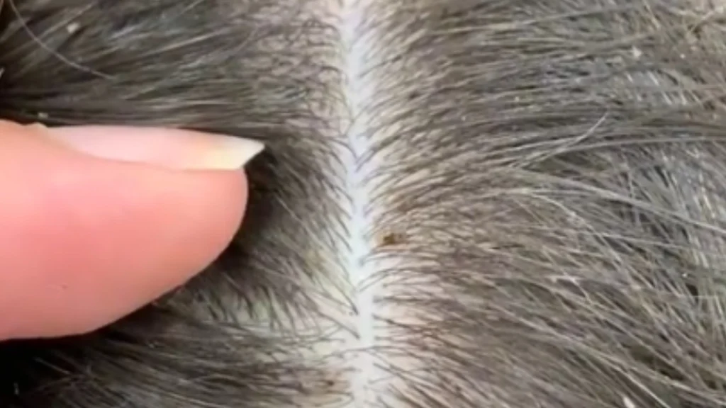 Frisør deler video, der får hovedbunden til at klø: Vent til du ser, hvad hun finder