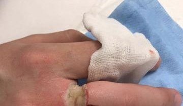 18-årige Marcus købte billig ring: Kostede ham næsten fingeren