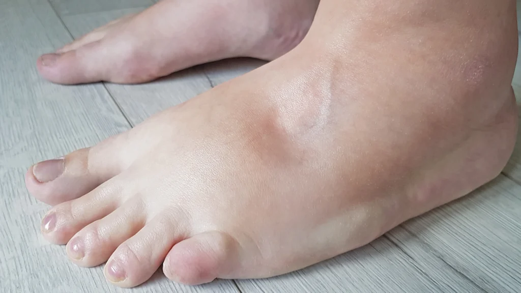 7 simple råd: Sådan slipper du af med hævede fødder og ankler
