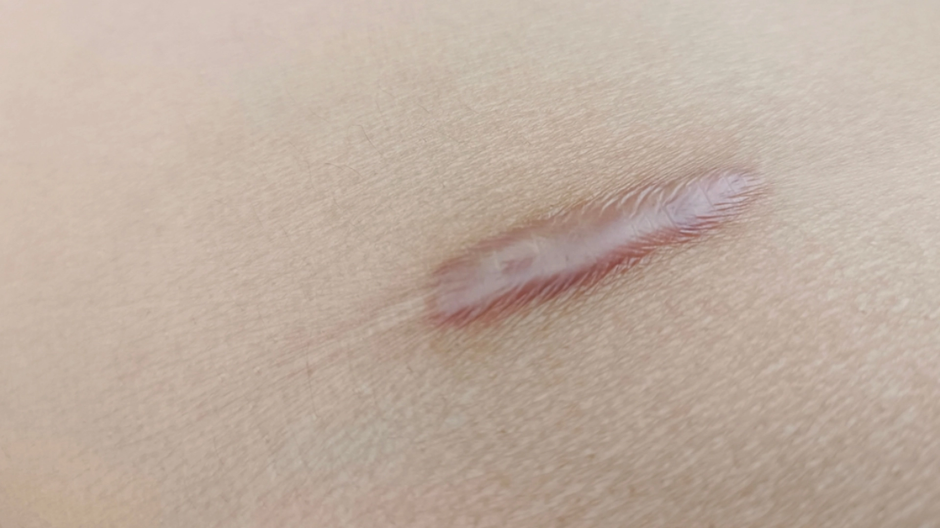 Hudlæge med afsløring: Her er de 3 bedste tips til mindre synlige og mindre kløende ar