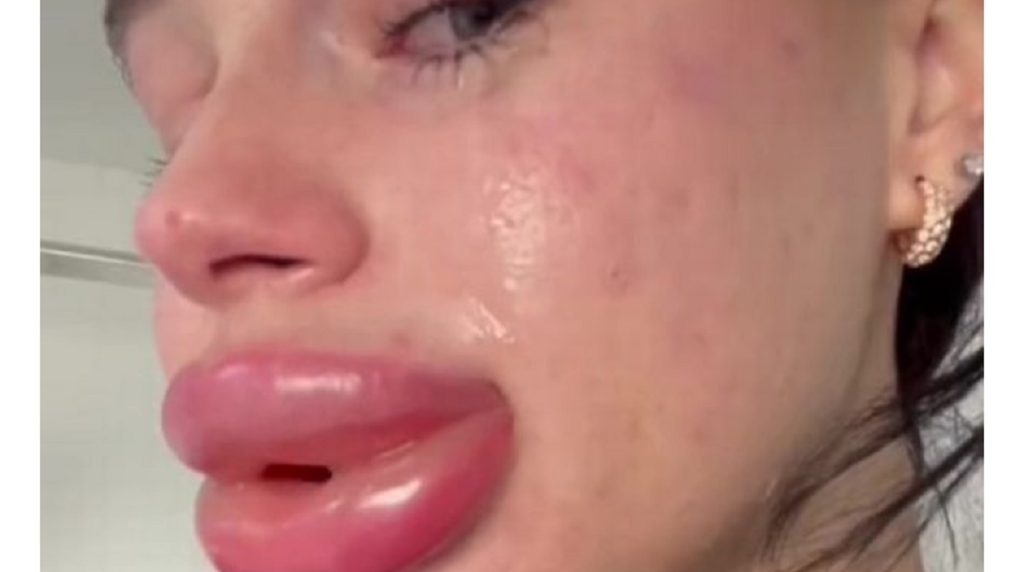 Fillers gik helt galt: Nu ligner hun en tegneseriefigur