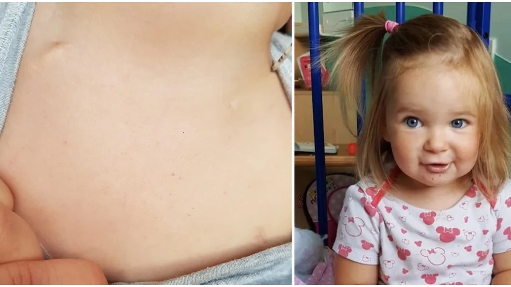 Laura var forundret over blå mærker på sin datter: Da hun tjekkede på nettet, opdagede hun den grufulde sandhed