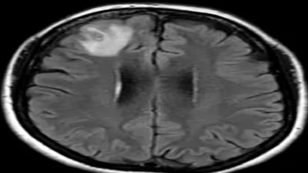 Kvinde oplevede glemsomhed og depression: Så gør lægerne chokerende fund i hendes hjerne