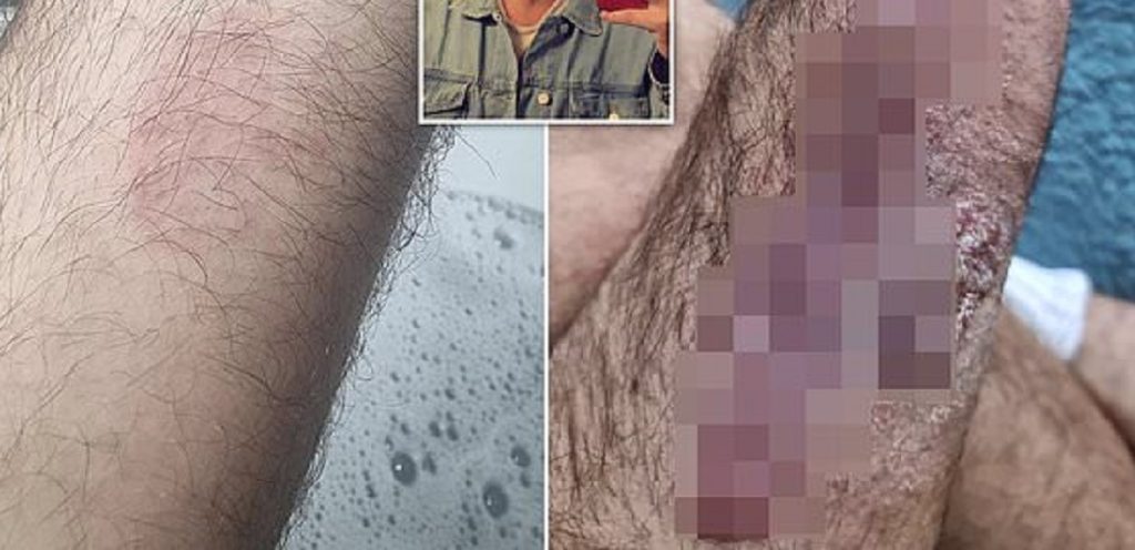 Mand brugte særlig shampoo – nu advarer han andre