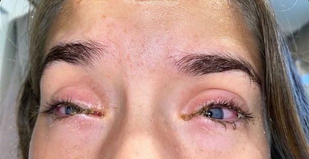 Teenager blev kortvarigt blind efter brug af dette produkt