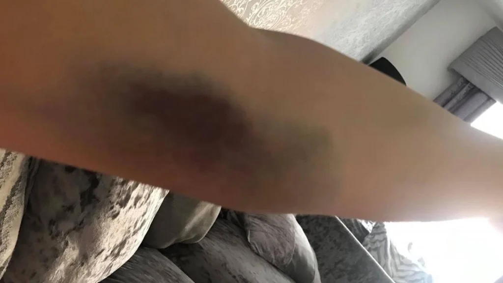 Tragisk skæbne for 22-årig mor: Gik til lægen med blå mærker – Ugen efter var hun død