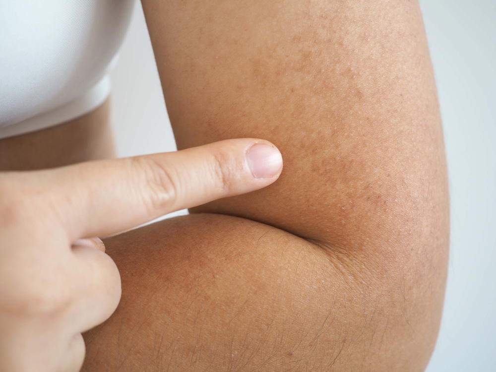 Deres bid er lige så farligt som flåter. På huden ligner de små væsner bare et modermærke.