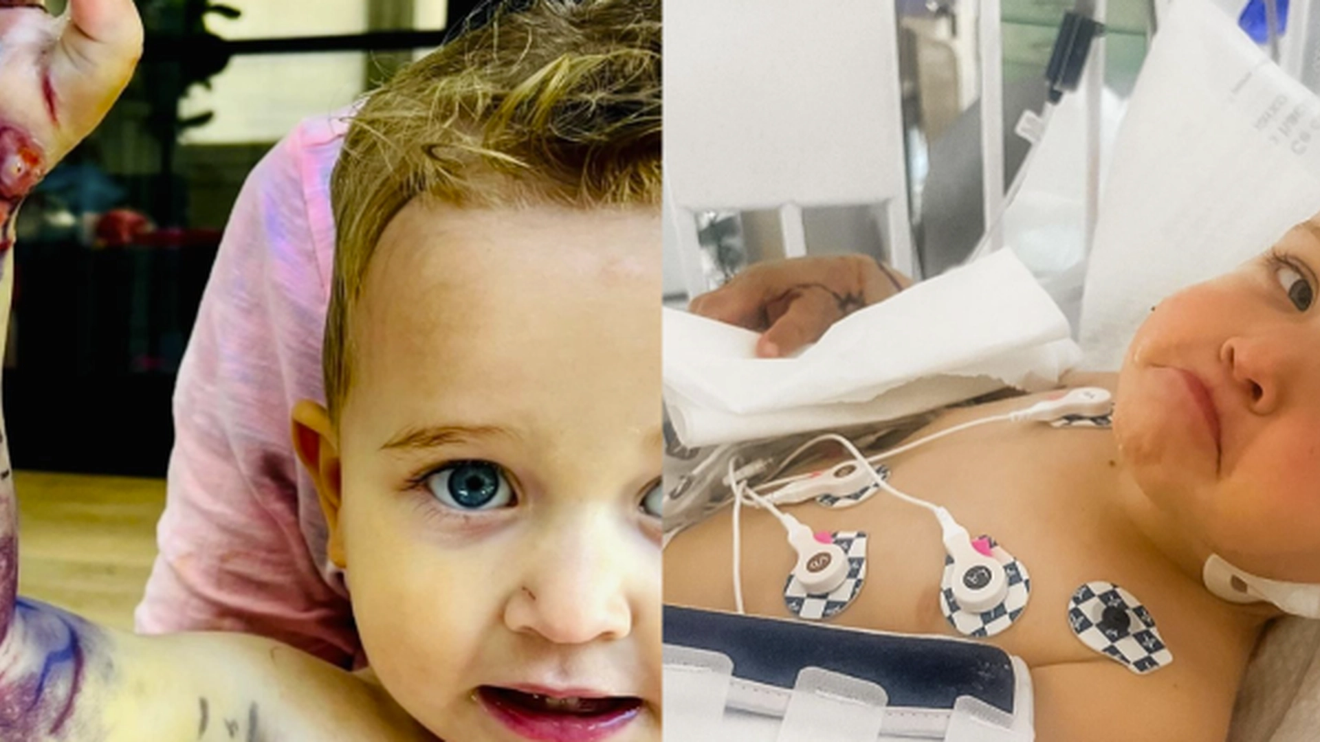 2-årig bidt af klapperslange: Du gætter aldrig, hvor meget familien skulle betale for den livsvigtige behandling