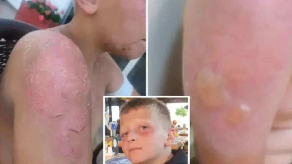 Solbrændt 11-årig fik ødelagt sin ferie: Nu advarer mor mod velkendt solcreme