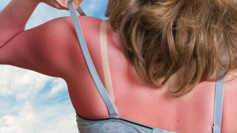 Mor deler effektiv behandling mod solskoldning: Garanterer smertelindring efter kun 30 minutter