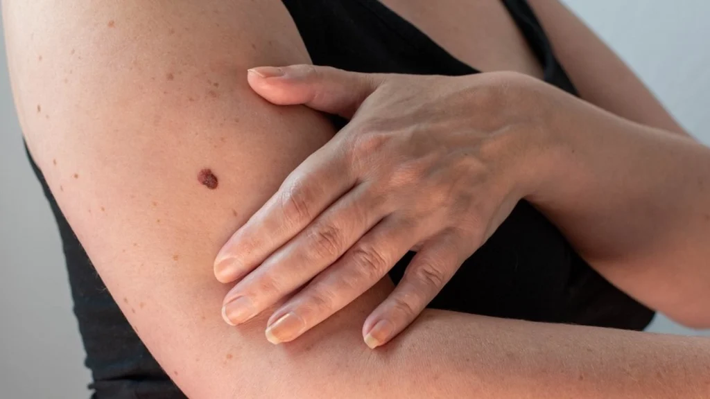 Ekspert advarer: Tegn på hudkræft kan opstå efter blot 15 minutter i solen