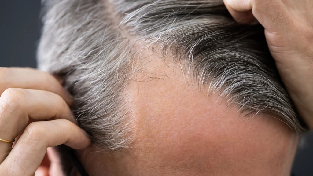 Er du plaget af hårtab? Dermatolog og kirurg forklarer, hvorfor du bør handle hurtigt