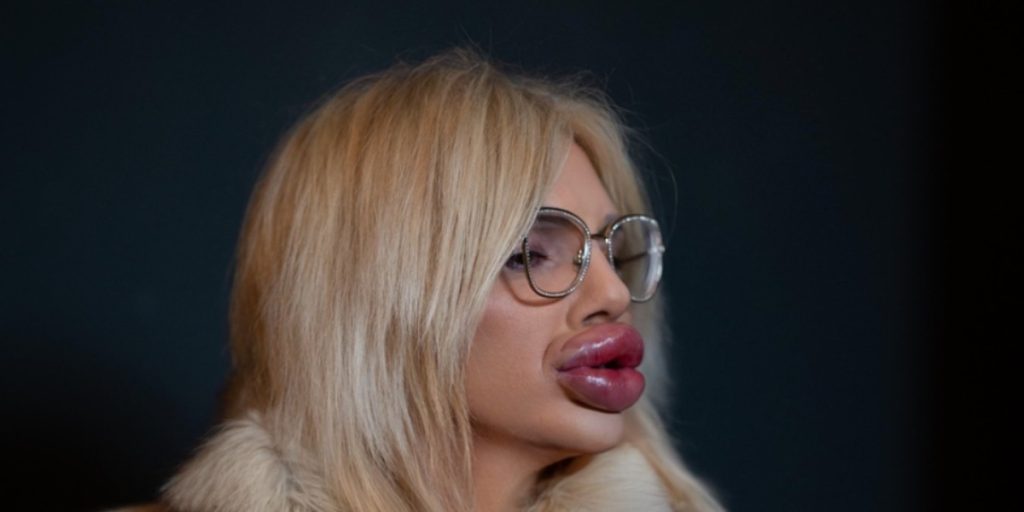 Hun har de ‘største læber i verden’: Du vil ikke tro, hvad de har kostet hende